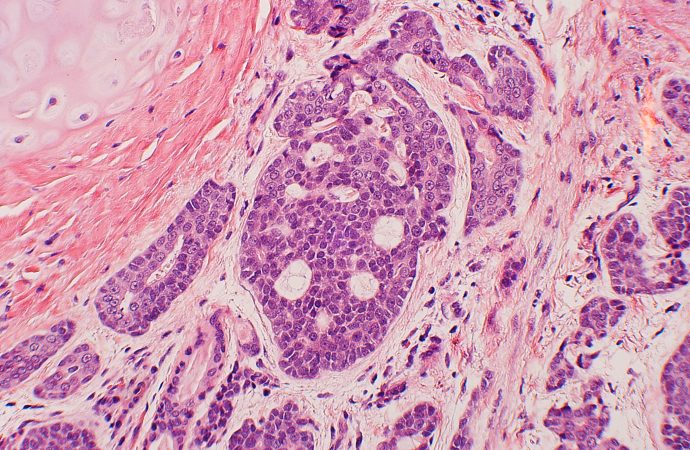 "Adenoid cystic carcinoma" by Yale Rosen. https://www.flickr.com/photos/30950973@N03/5600774541