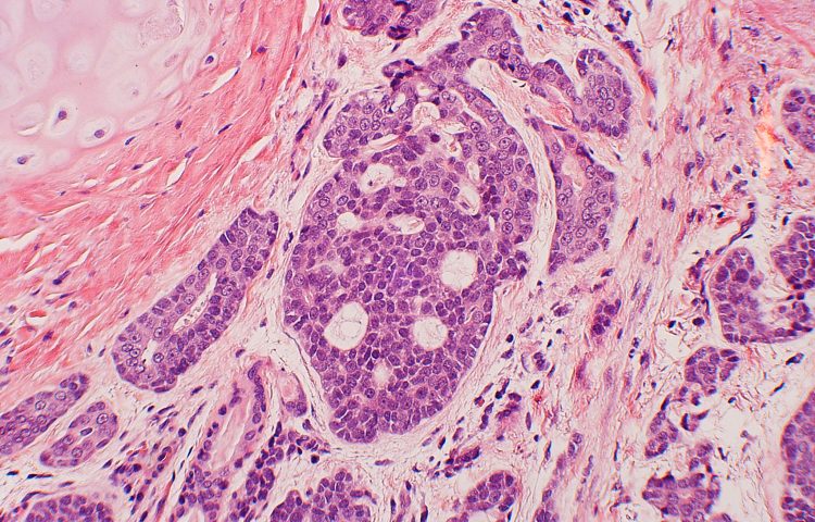 "Adenoid cystic carcinoma" by Yale Rosen. https://www.flickr.com/photos/30950973@N03/5600774541
